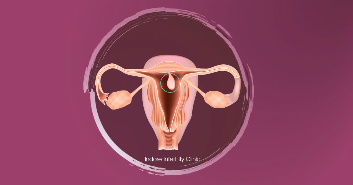 How Does A Uterine Polyp Impact Your Chances Of Having A Baby