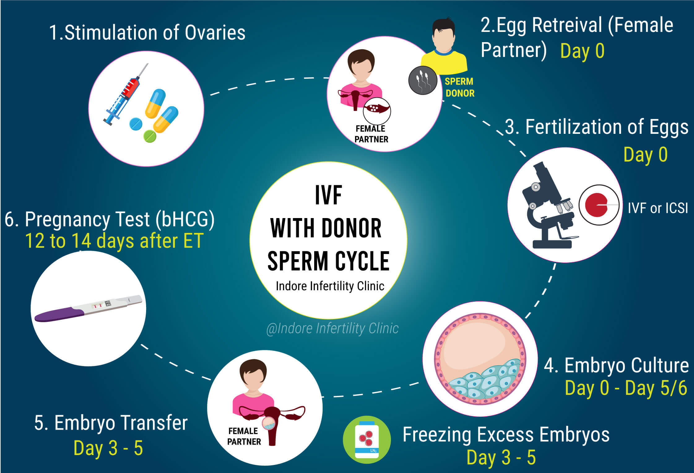 Ivf With Donor Sperm Steps Get Best Solution On Ivf At Ivf Center Indore 1 Indore Ivf Center