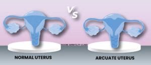 Arcuate Uterus vs Normal Uterus