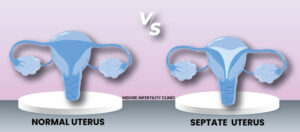 Normal vs Septate Uterus
